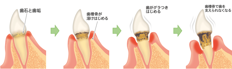 歯周病