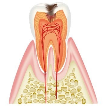 大きなむし歯でも神経を残せる場合があります